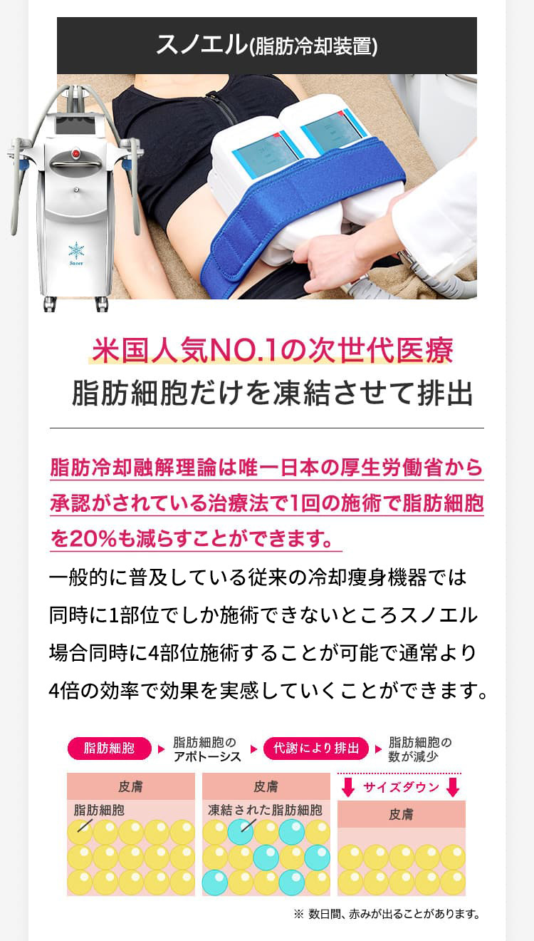スノエル(脂肪冷却装置)